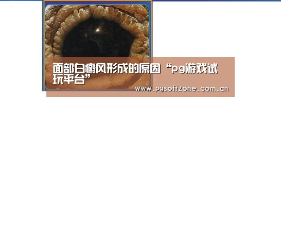 面部白癜风形成的原因“pg游戏试玩平台”(图2) pg游戏试玩平台